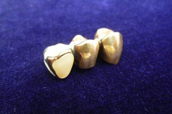 「金歯も立派な金製品　意外とイイ金額になります　沼津市の金のクマ」　銀歯も買い取り大歓迎です