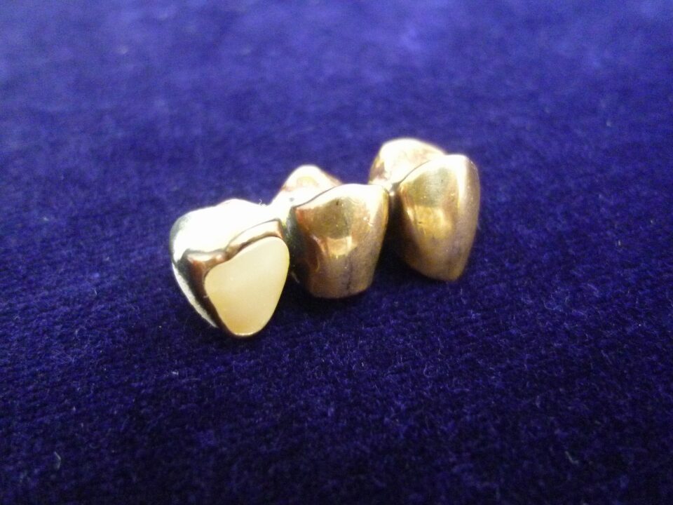 「金歯も立派な金製品　意外とイイ金額になります　沼津市の金のクマ」　銀歯も買い取り大歓迎です